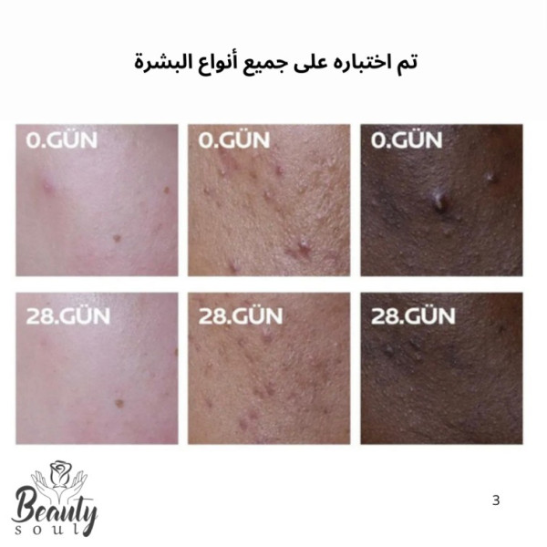  لاروش بوزيه إيفاكلار ديو (+)، وهو علاج شامل لحب الشباب بحجم 40 مل